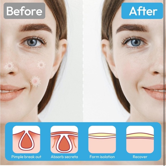 280 Hydrocolloid Acne Patches, Zit Patches for Day and Night Invisible - Picture 4 of 9